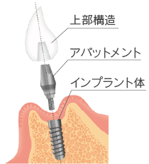 インプラント治療にかかる費用の総合情報の説明画像3