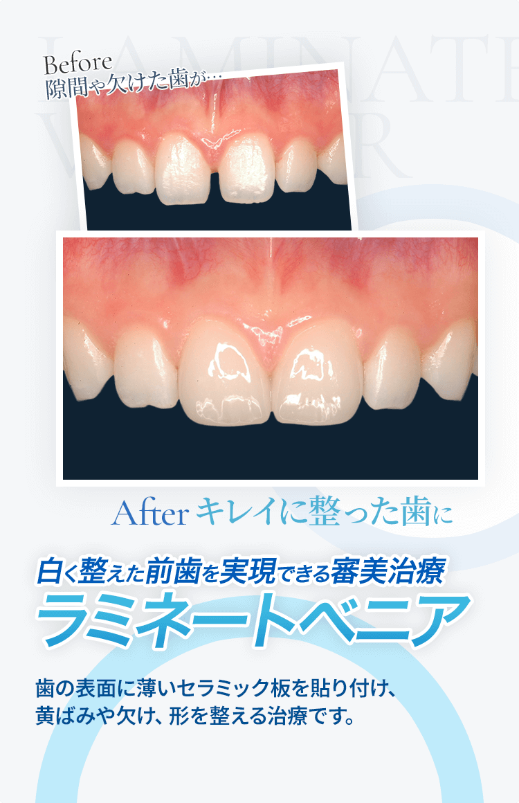 ラミネートベニア