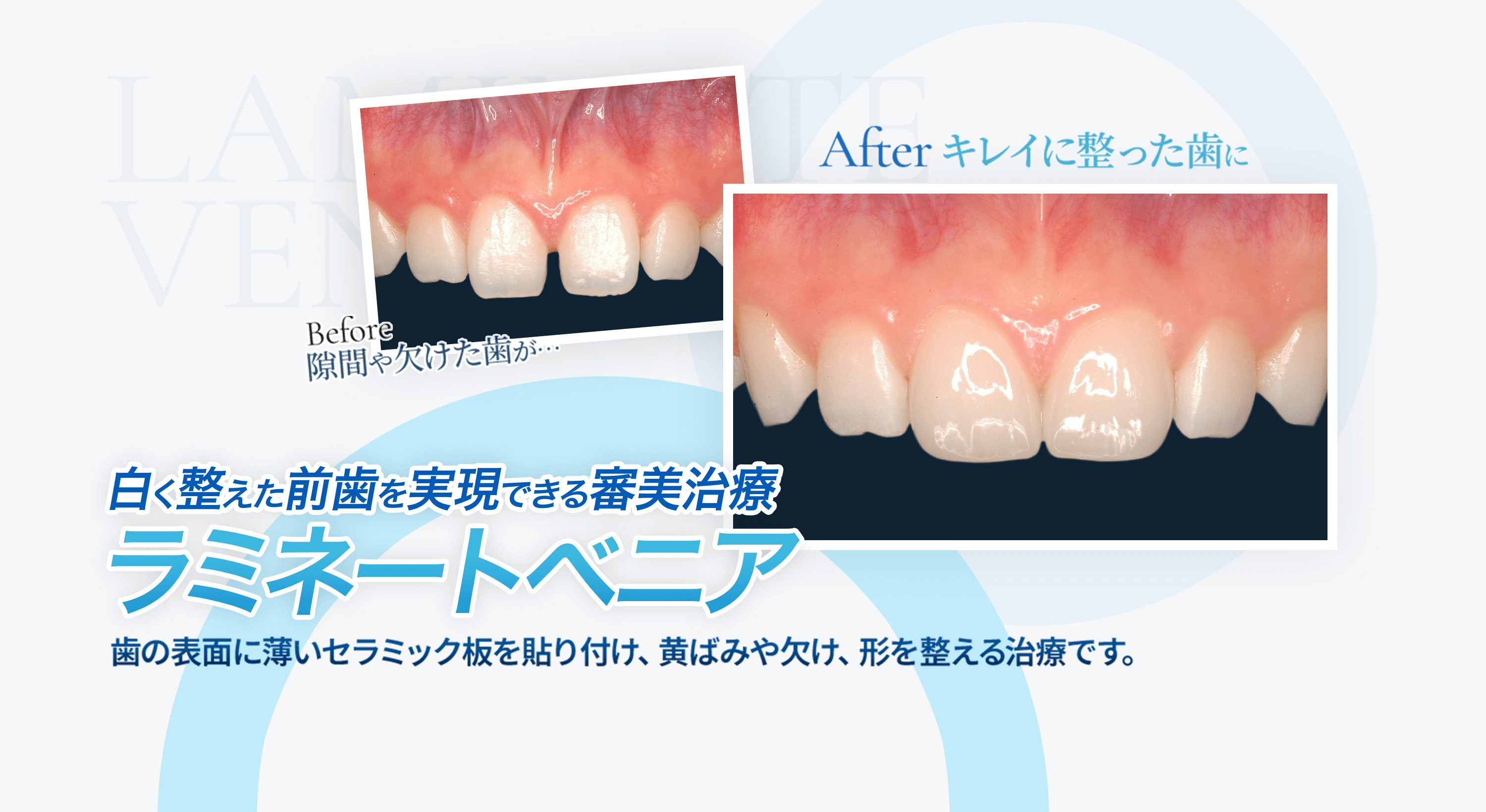ラミネートベニア