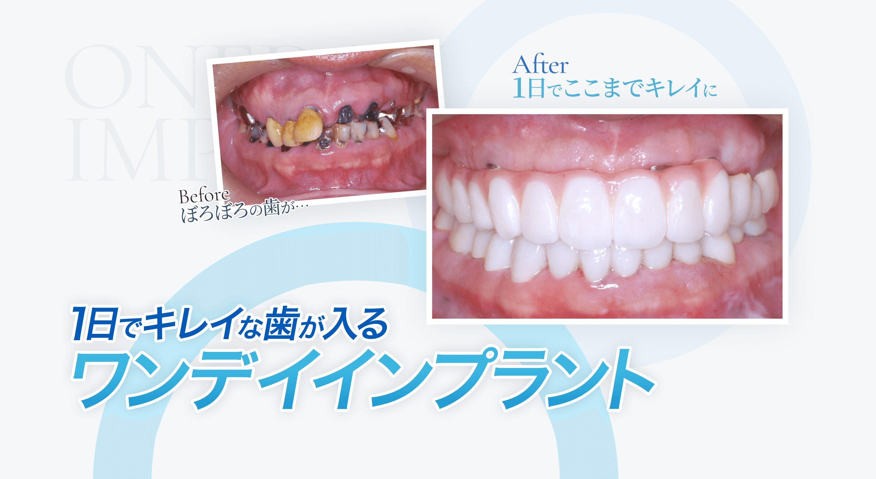 一日できれいな歯が入るワンデイインプラント