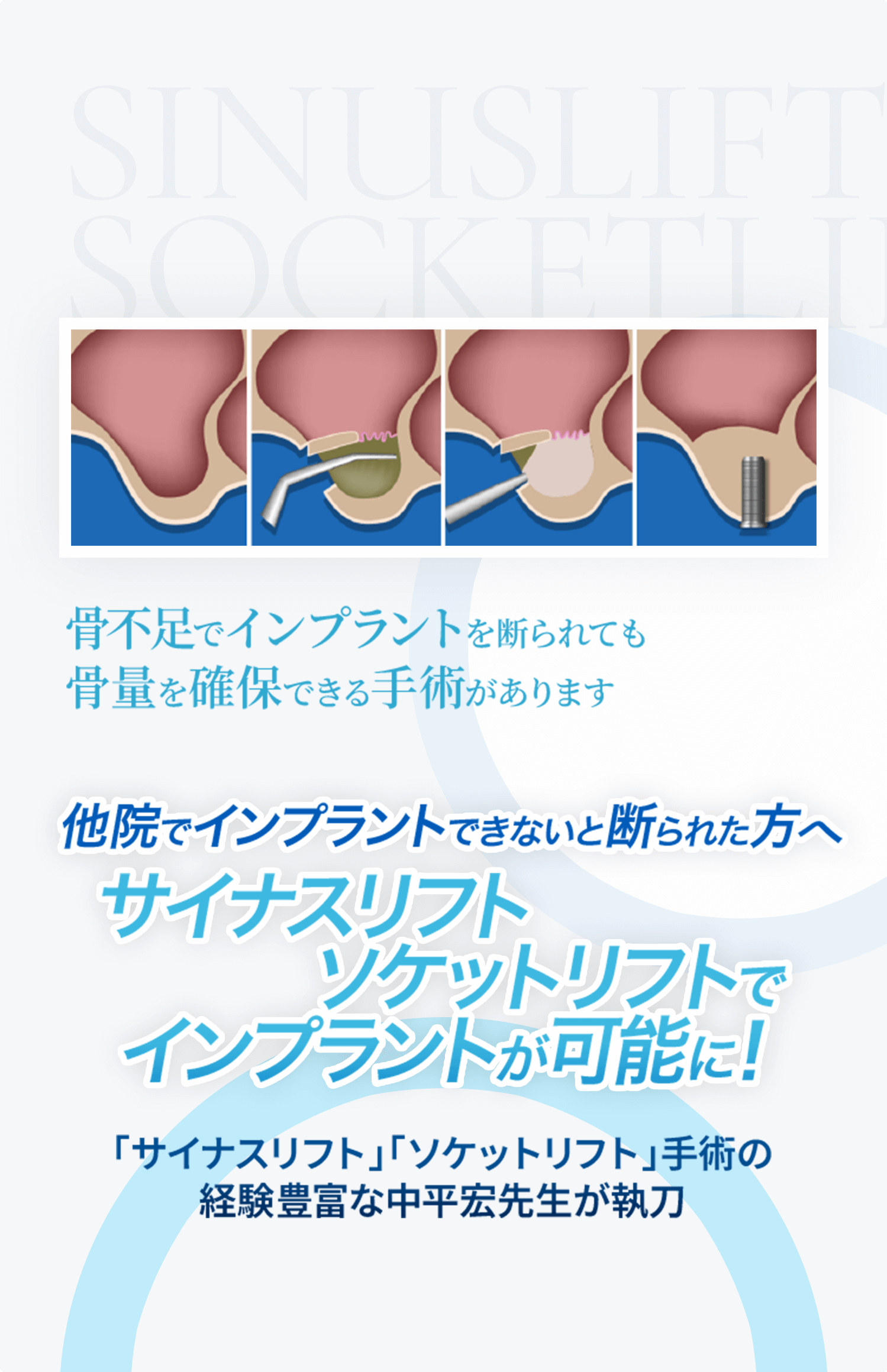 サイナスリフト・ソケットリフトで インプラントが可能に！ 