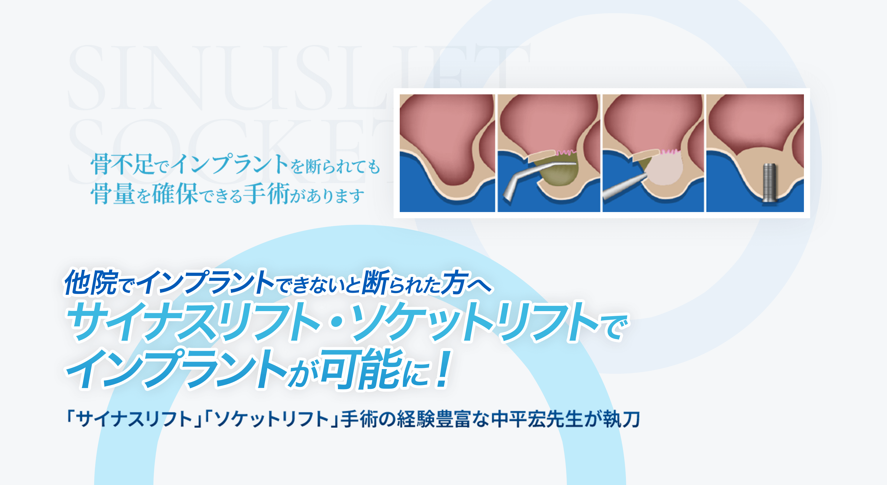 サイナスリフト・ソケットリフトで インプラントが可能に！ 