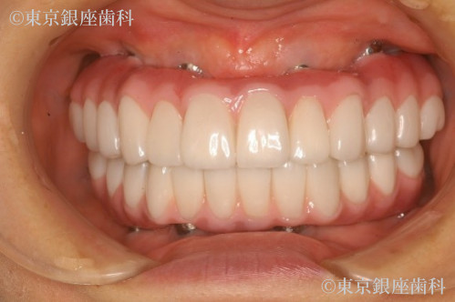治療後の口腔内写真