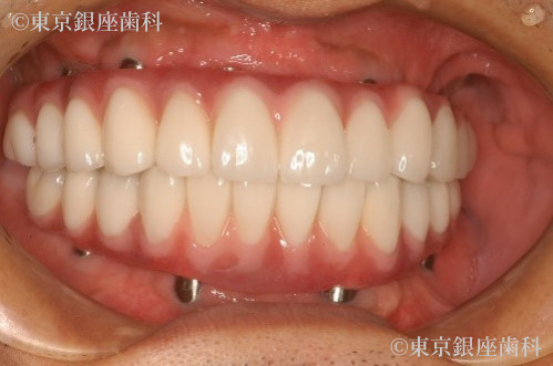 治療後の口腔内写真