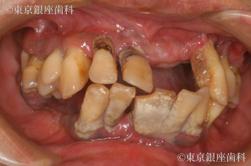 治療前の口腔内写真
