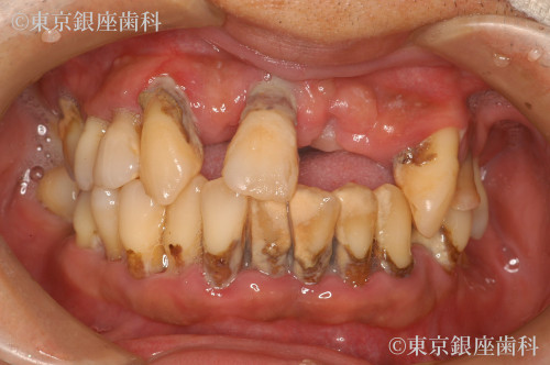 治療前の口腔内写真