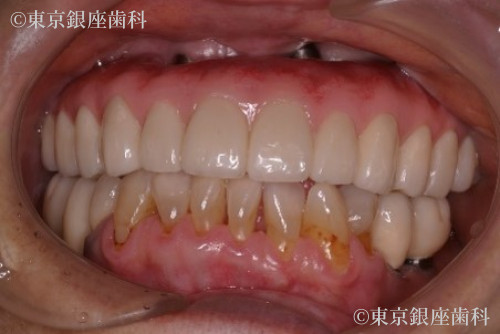 治療後の口腔内写真