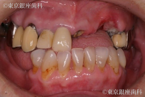 治療前の口腔内写真