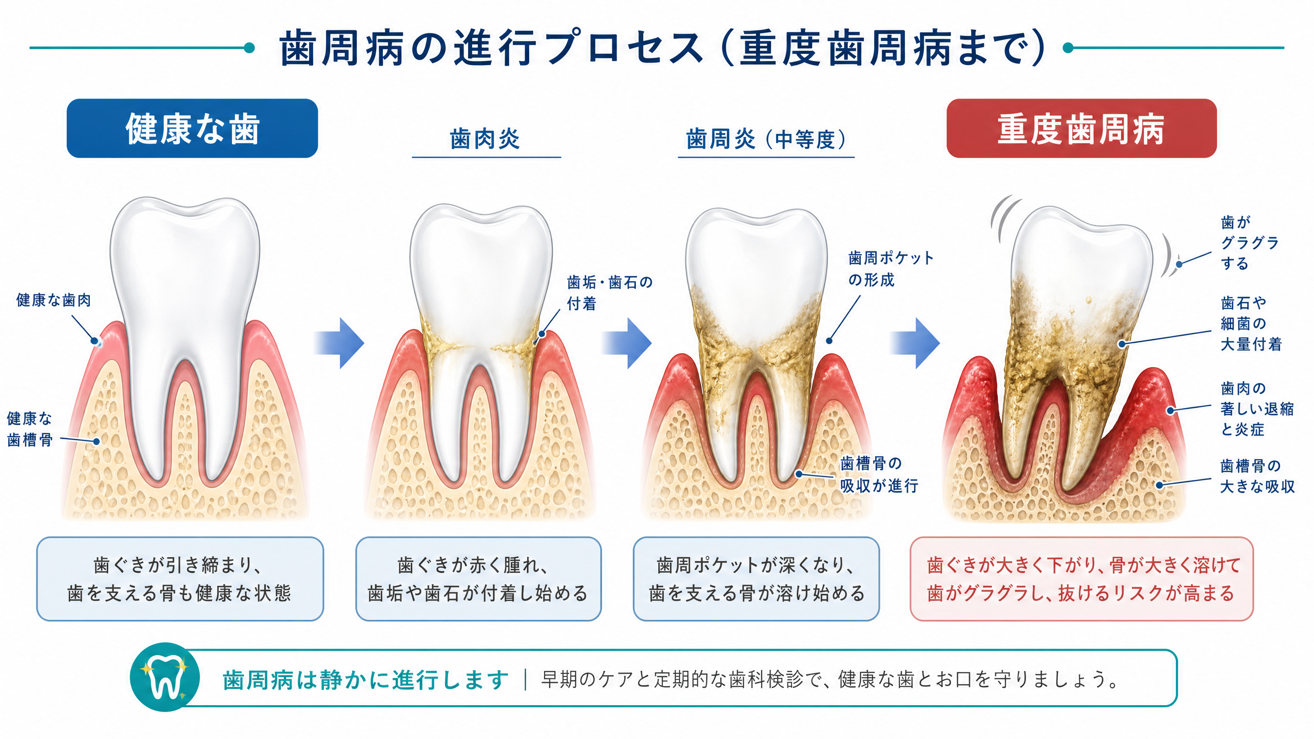歯周病の進行プロセス